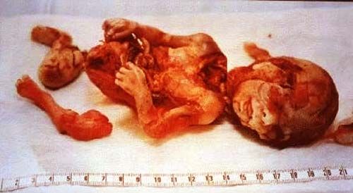 abortion2.jpg